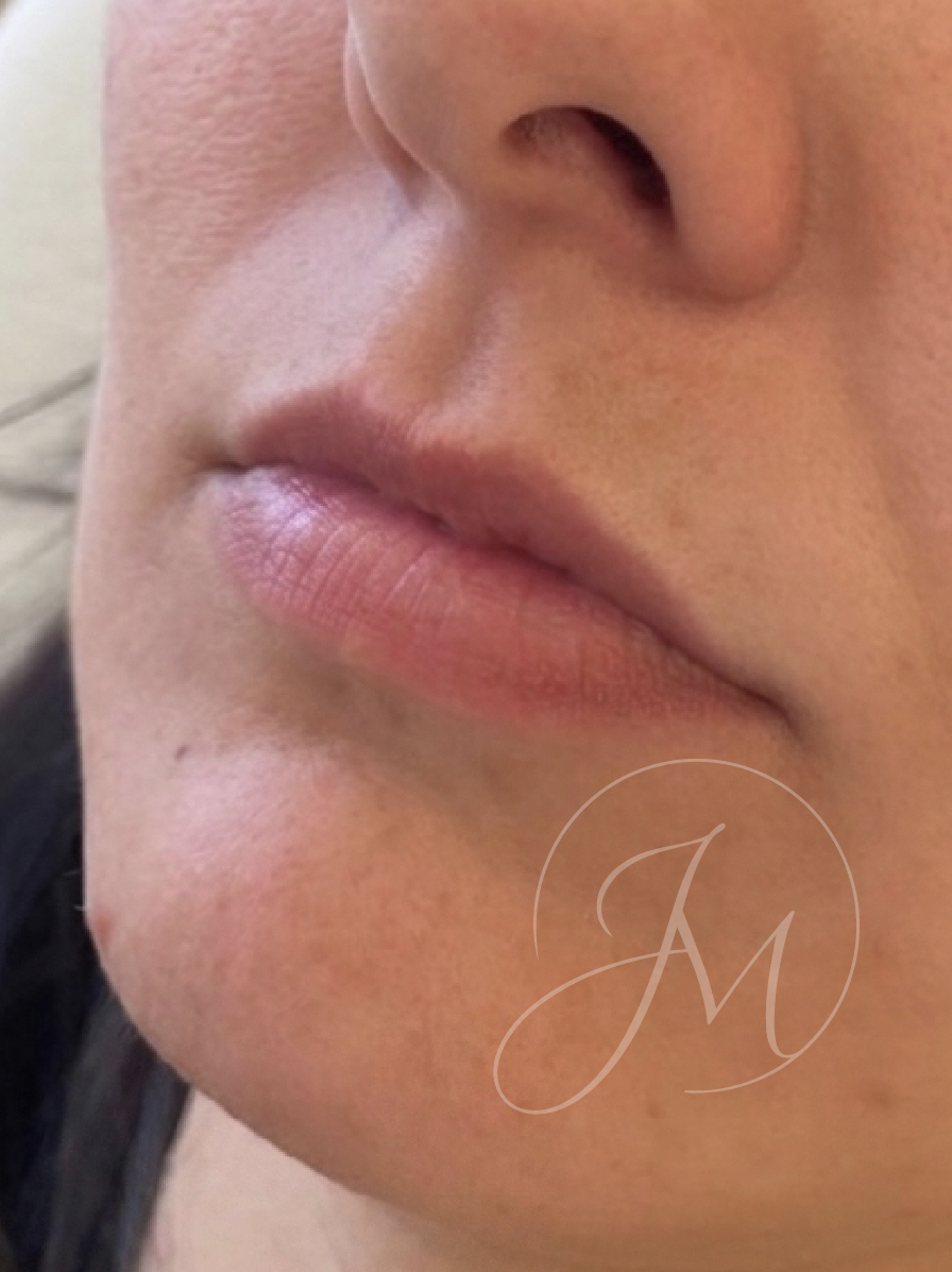 Antes armonización facial labios