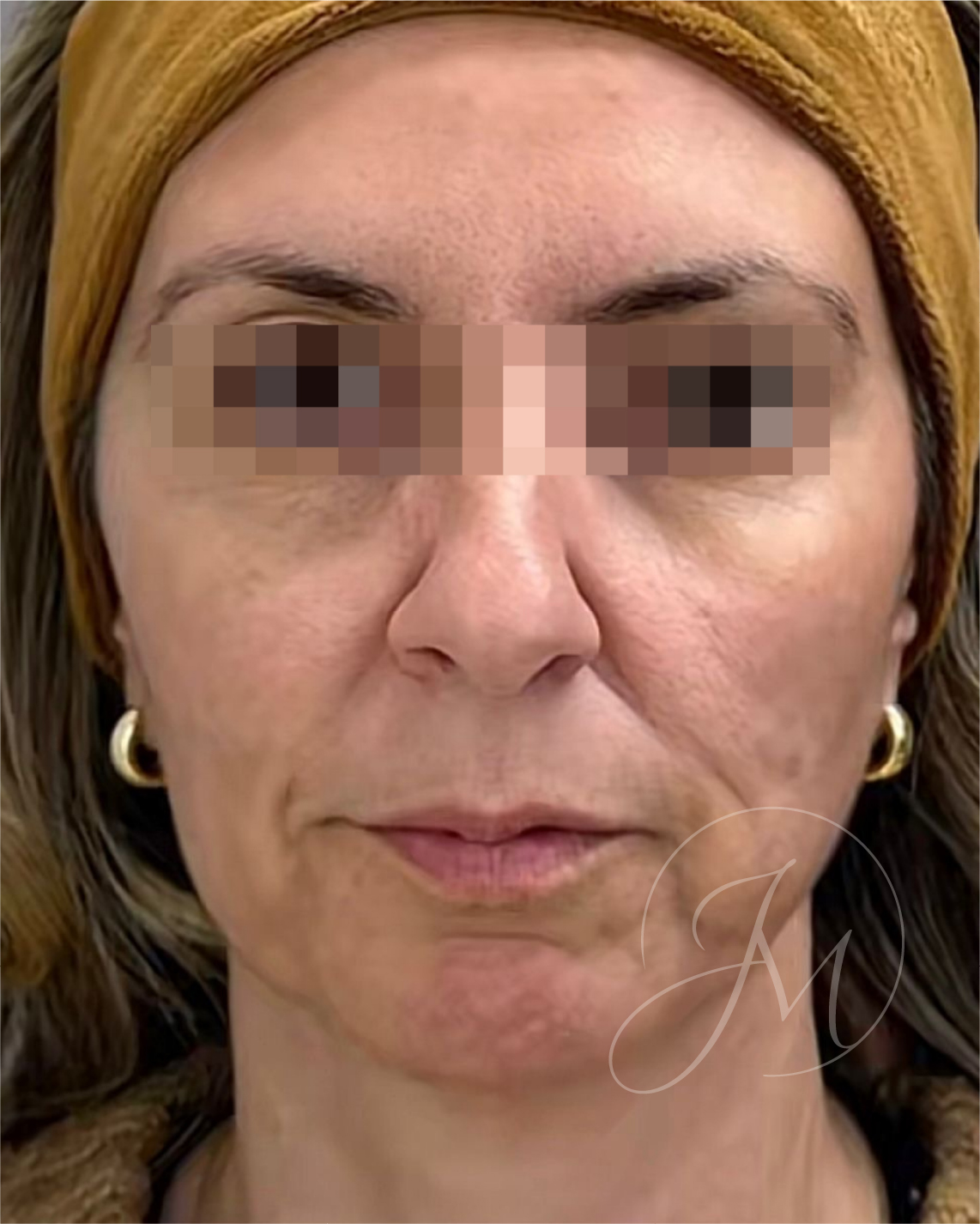 Antes lifting facial sin cirugía