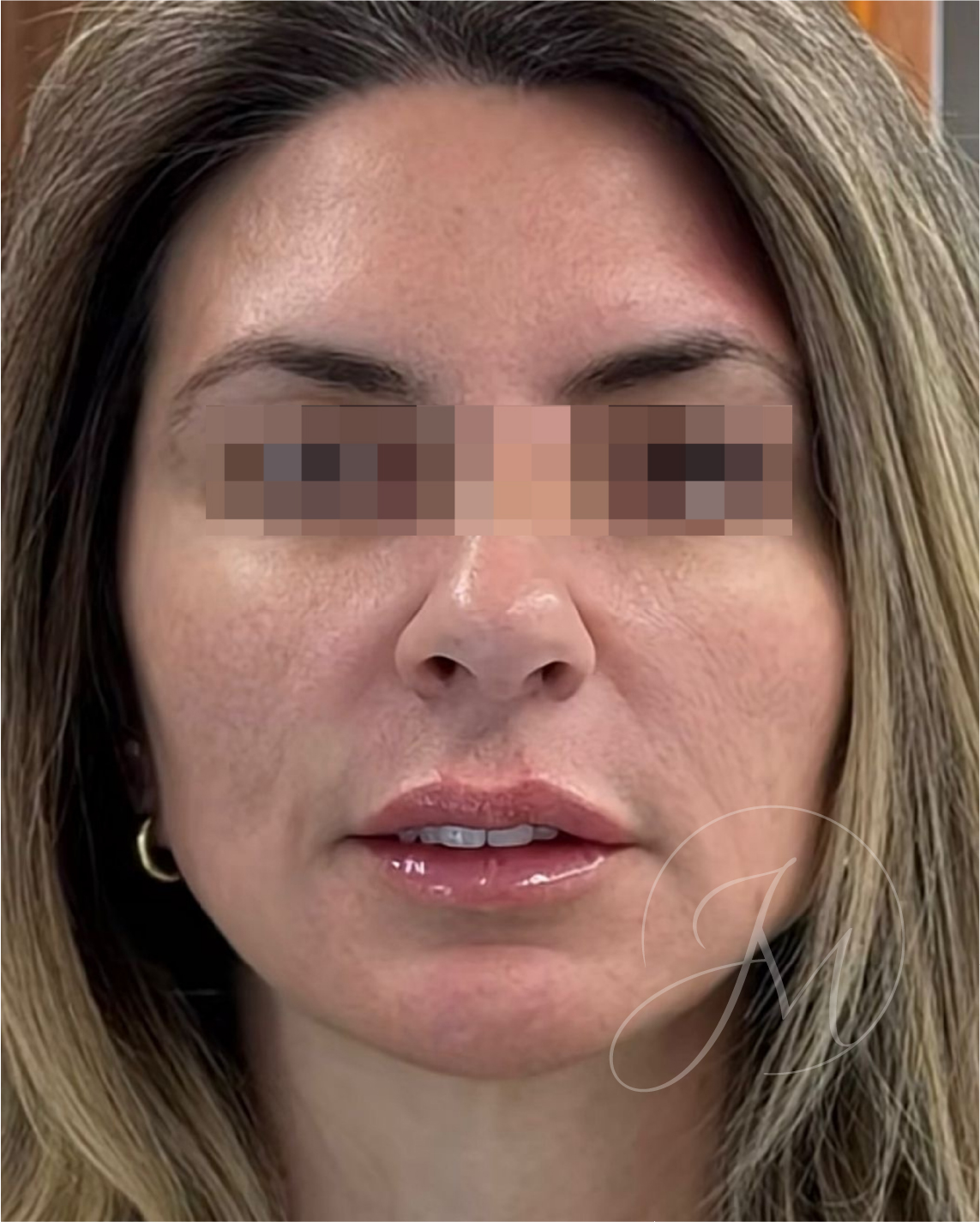 Después lifting facial sin cirugía