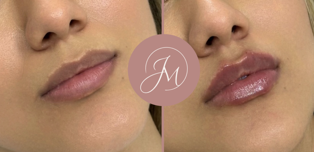 rellenos dérmicos faciales labios antes y después Guayaquil