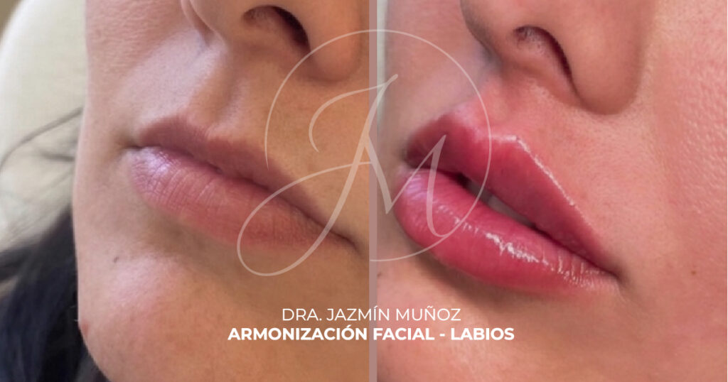 Rellenos de labios Guayaquil antes y después - Dra. Jazmín Muñoz