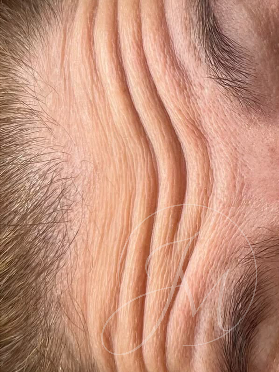 Antes arrugas frente neuromoduladores Guayaquil